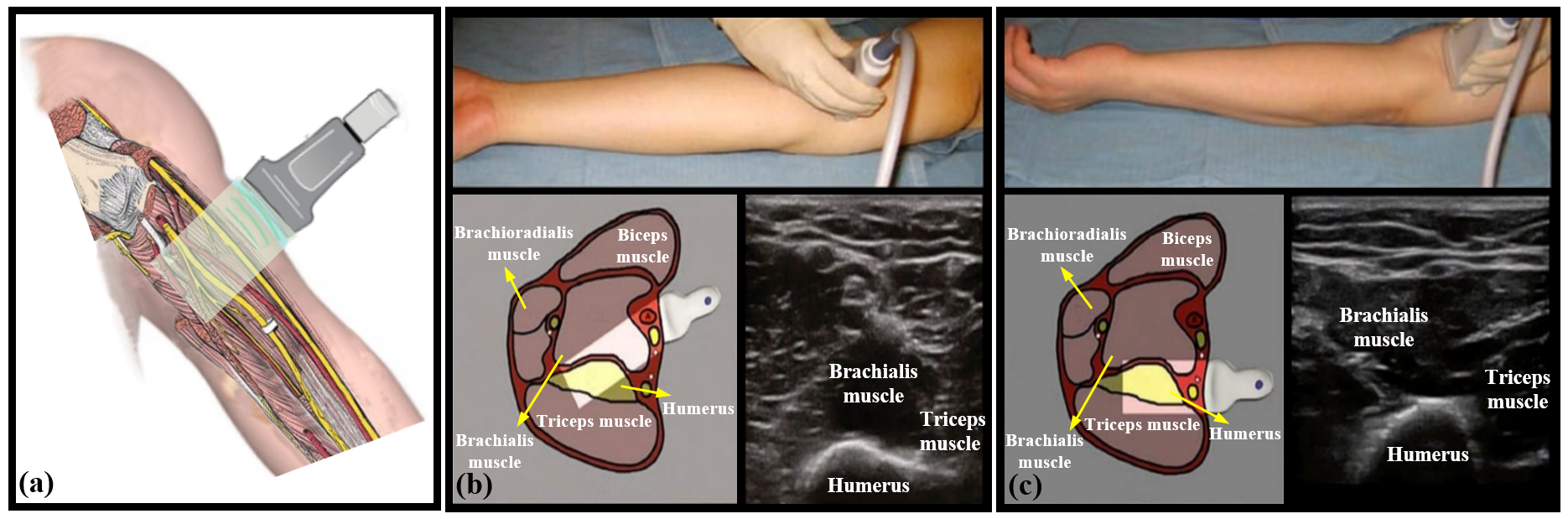 Examples of arm MSKUS